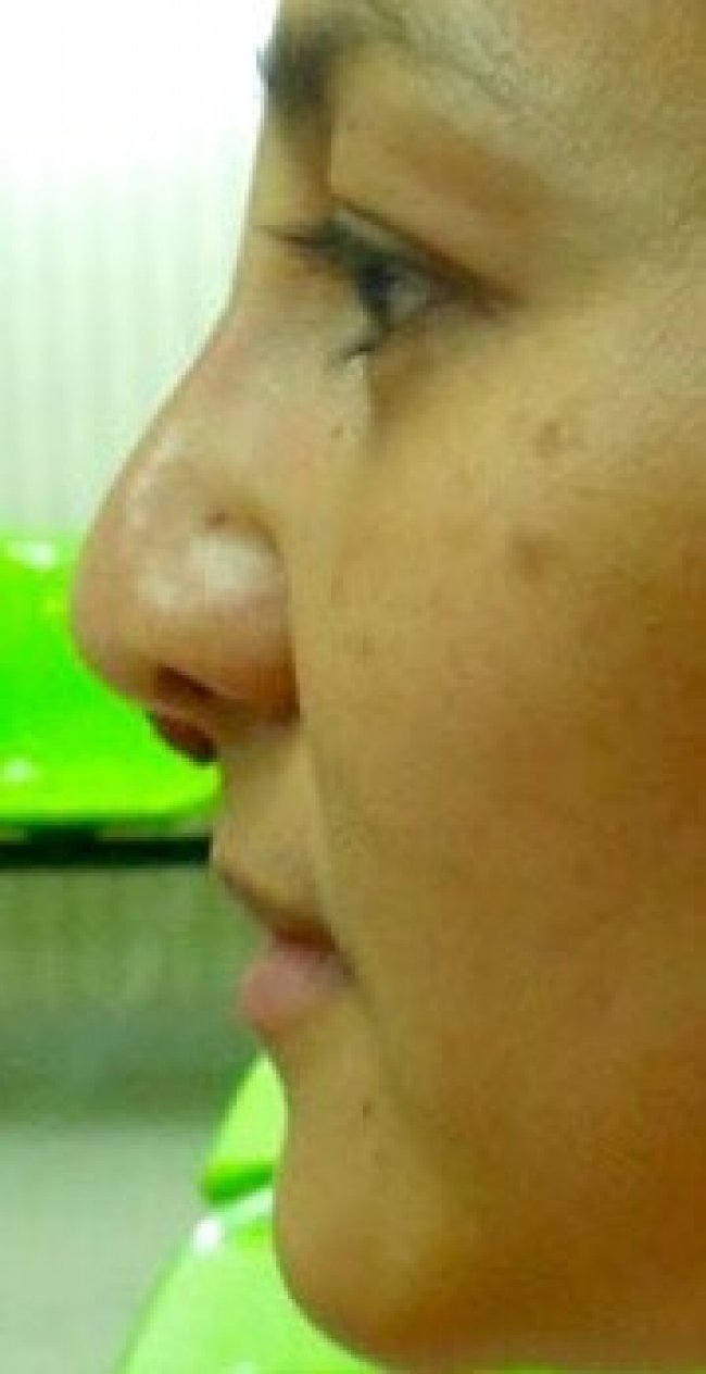 ศัลยกรรมแก้ไข จมูกและใบหน้า เพื่อเสริมบุคคลิกภาพ 1